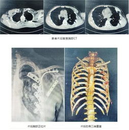 肋骨骨折手术固定图片 搜狗图片搜索