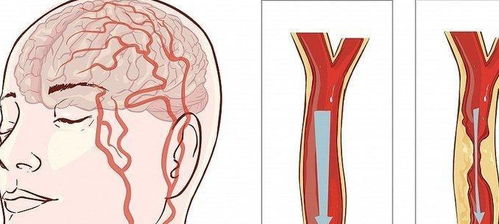 颈动脉斑块脱落有脑梗风险 想要 化斑 记好这三件事
