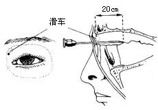 泪囊鼻腔吻合术