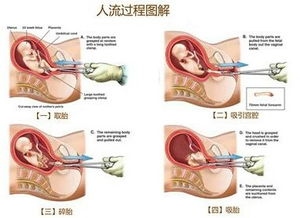 无痛引产大概得多少钱