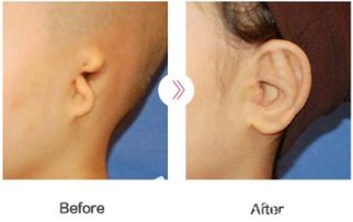 耳朵畸形矫正 耳再造医院 韩国普罗菲耳profile郑在皓讲小耳症术后可能会有哪些并发症