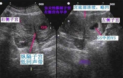 什么是纵膈子宫 纵膈子宫对怀孕有哪些影响