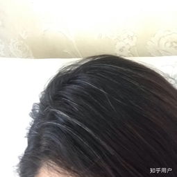 年纪轻轻的女孩子有白头发怎么办 