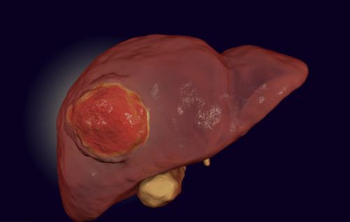 肝恶性肿瘤从1cm发展到5cm,要多久 医生说出答案,多数人沉默了