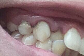 牙齿黑黑的点是什么东西