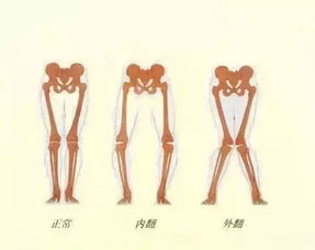 23岁女孩两腿并拢会剧痛 1000多万人因为这项运动 坑 进医院