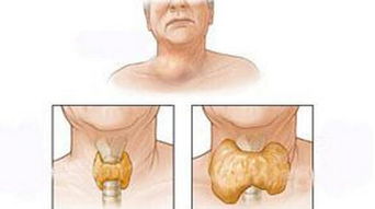 甲状腺疾病能防治,是一种你不知道的微量元素 