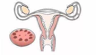 肥胖并且患有多囊卵巢综合征怎样通过试管婴儿怀孕？