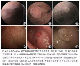 胶囊内镜 CT 钡餐可以取代普通胃肠镜检查吗