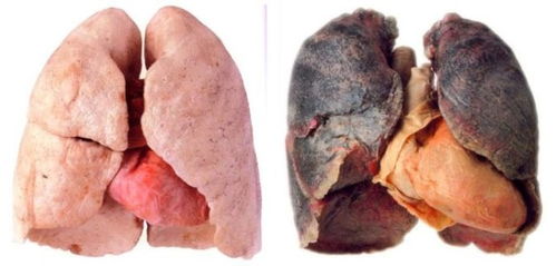 抽烟为什么肺会变黑 戒烟以后,黑色还能恢复粉色吗