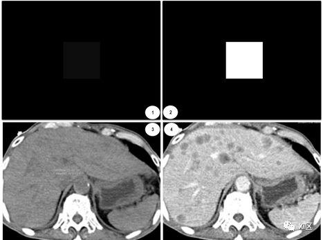 CT实质脏器增强检查 你真的会做吗