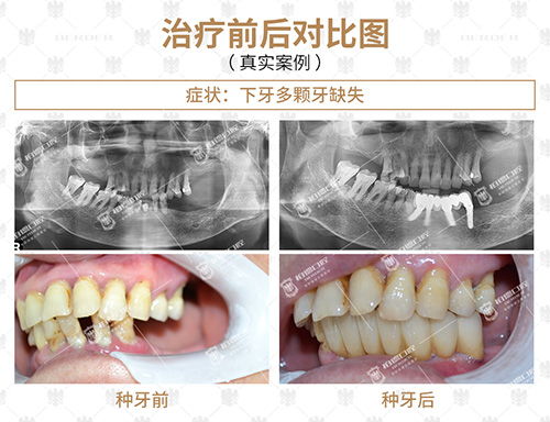 后槽牙不建议种牙拔掉吗