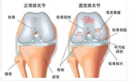 最伤膝盖的动作,你还在天天做吗