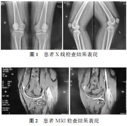 骨梗死早期影像学表现1例 