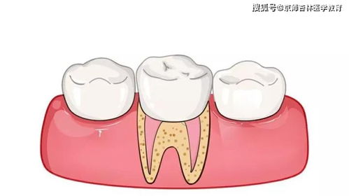 隐适齐 根管治疗后的牙齿还能使用多久