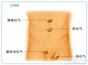 小儿疝气不手术可以治愈吗