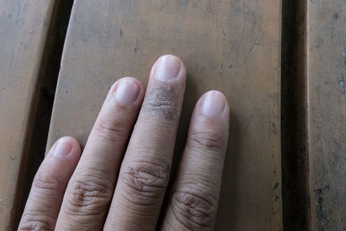 脚拇指指甲凹凸不平是什么原因(脚拇指指甲凹凸不平是什么原因图片)