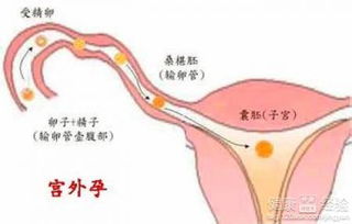 宫外孕手术需要多少钱