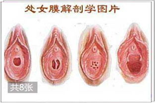 高清图解 处女膜的几种常见形态