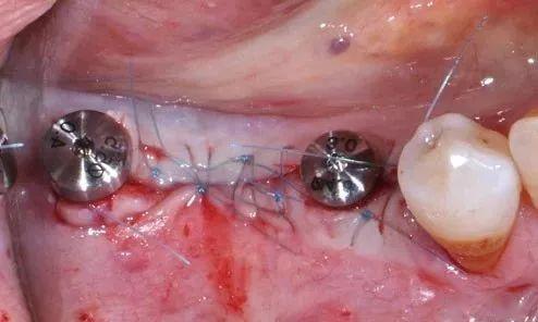 口腔种植手术中常用的外科缝合技术归纳总结