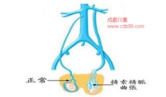 前列腺炎会导致精索静脉曲张吗 