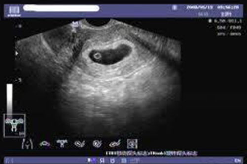 孕囊和蜕膜完整图片,标签：孕囊，蜕膜，胚胎发育，生物学，解剖学