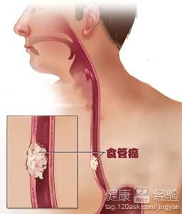 食管癌手术后要怎样食疗呢