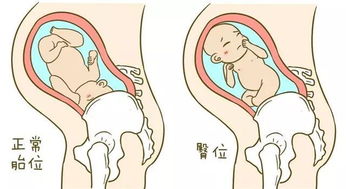 胎儿如果是臀位会影响分娩吗应该怎么纠正，如果纠正不过来怎么办