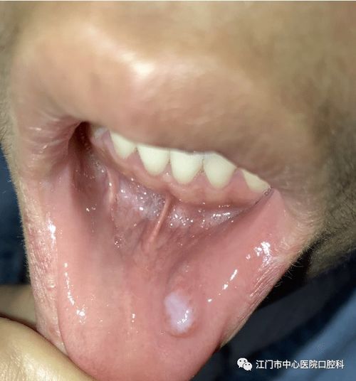 经常咬嘴巴居然导致囊肿 这个坏习惯很多人有