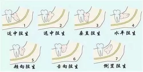 新型冠状病毒肺炎疫情期间,智齿发炎了怎么办