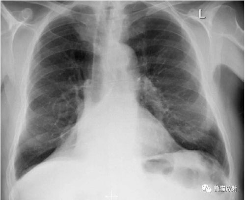 支气管肺癌的影像特征