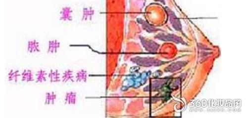 乳腺囊肿需要治疗吗(良性乳腺囊肿需要治疗吗)