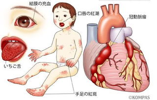 把这个病当普通感冒治,后果很严重