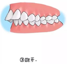 芳龄28 牙齿矫正还来得及吗 鹏程口腔