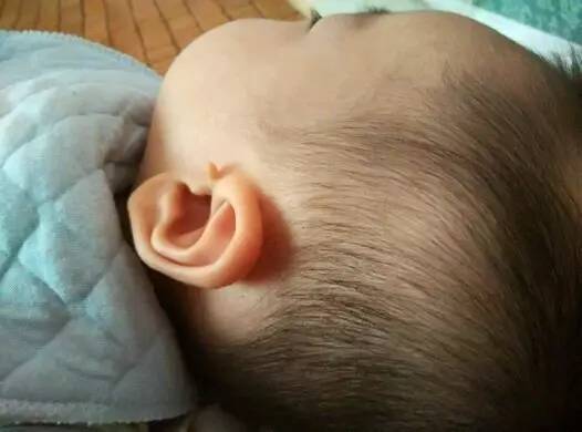 耳朵上拴马桩留着没事儿,但两个月婴儿这么治疗却直接被全麻