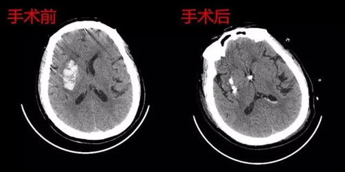 五旬大妈突然 中风 ,原因竟然是...... 