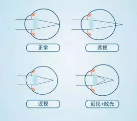 散光介绍 散光是屈光不正的一种,与角的弧度有关 角膜 