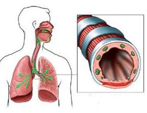 气管扩张能活多久 导致支气管扩张有哪些诱因