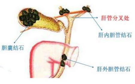 不同时期胆结石的不同表现