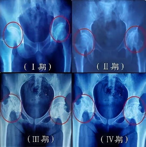 股骨头坏死专用药是专门针对股骨头坏死的？