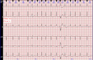 心房颤动心电图(心房颤动时心电图表现为)