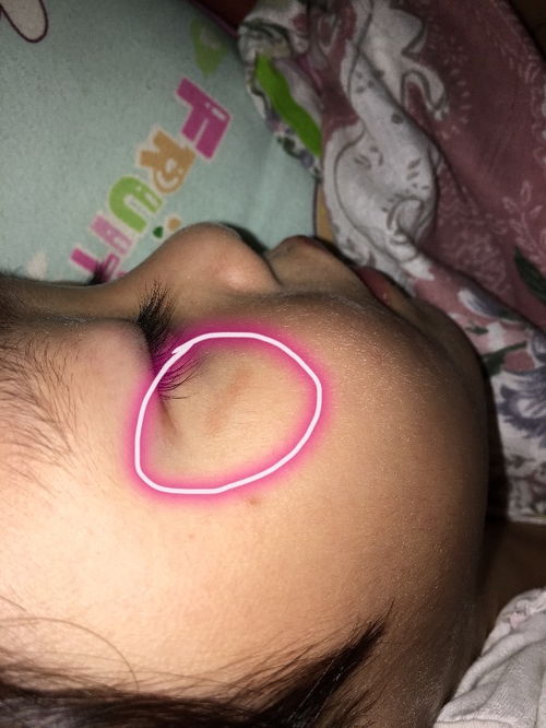 我女儿一个半月前,不小心蹭破了眼角的皮肤,现在一直有个深色的痕迹 