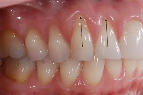 德国牙医拔下世界上最长牙齿,成功打破吉尼斯世界纪录