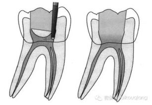 指导 根管治疗器械的选择