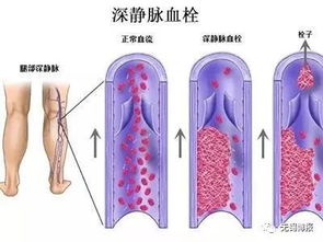 静脉血栓放滤网的费用