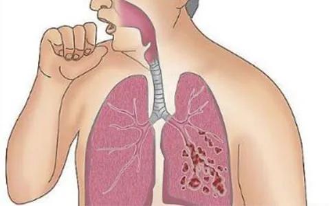 支气管炎哮喘如何根治,支气管炎哮喘如何根治？