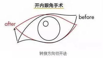 科普开内眼角和开外眼角