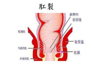 女性为什么容易肛裂呢