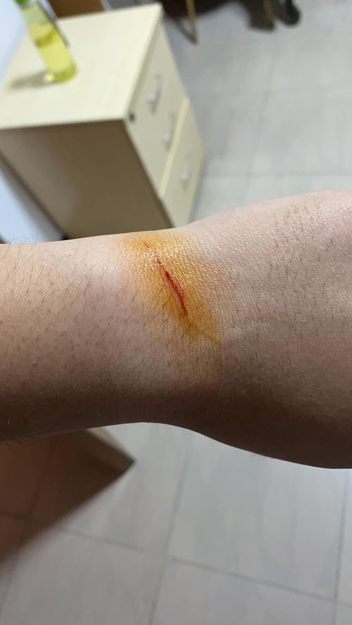 被猫抓伤了出血了怎么办 