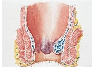 什么是痔疮 痔疮能自愈吗 有哪些危害